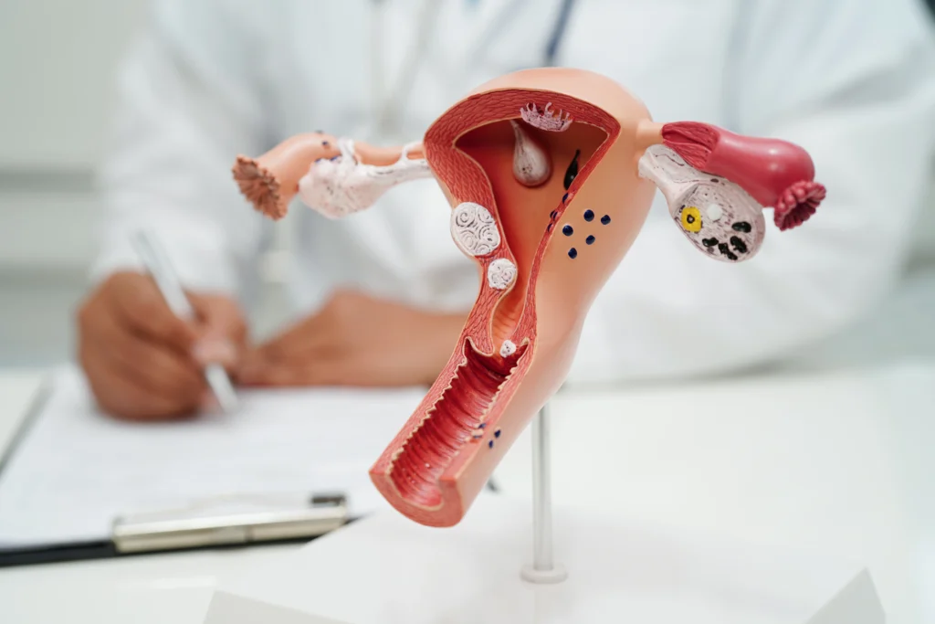 Ovarian Cyst Removal Surgery